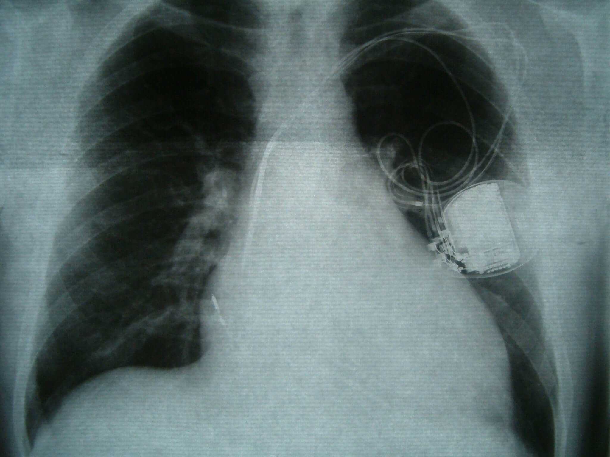X-ray of person with medical device in them